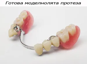 Готова моделно лята протеза