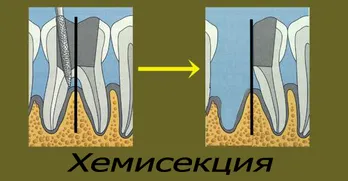 Хемисекция – отстраняване на единия корен на многокорен зъб