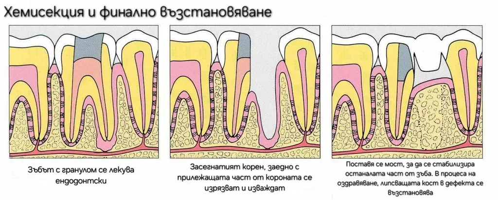 Схема на хемисекция при лечение на гранулом