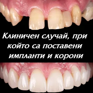 Импланти на мястото на липсващи зъби и корони върху останалите