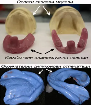 Индивидуални лъжици за отпечатък