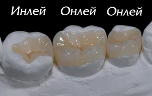 Керамични инлей, онлей и овърлей