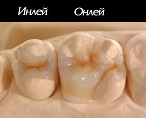 Керамичен инлей и онлей