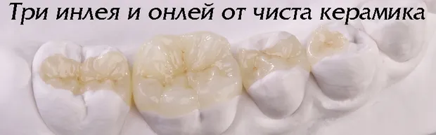 Керамичен инлей