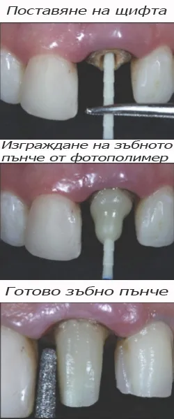Зъбно пънче, изградено около щифт в кореновия канал
