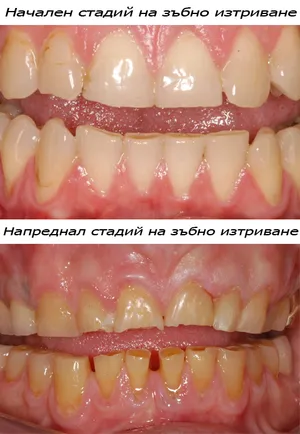 Изтрити зъби със засегнат емайл и дентин