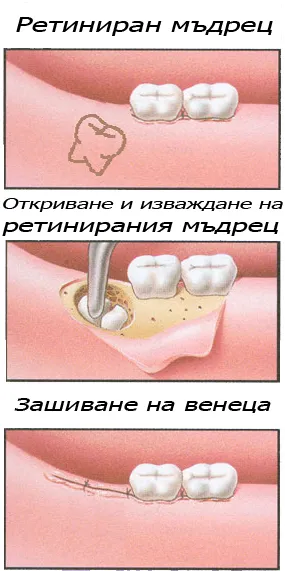 Етапи на оперативното изваждане на ретиниран мъдрец