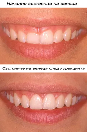 Корекция на контура на венеца при къси зъби