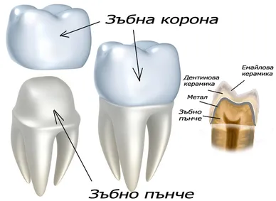 Металокерамична зъбна корона
