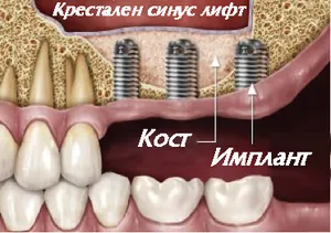 Крестален синуслифт през отвора за импланта