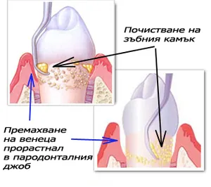 Закрит пародонтален кюретаж с кюрета