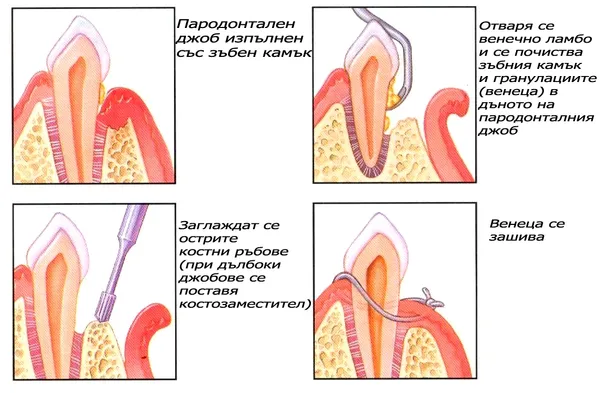 Открит кюретаж – почистване на пародонталния джоб под пряка видимост