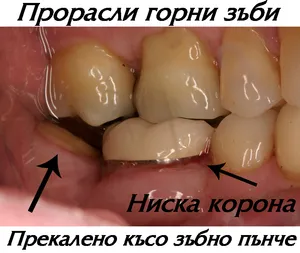 Къси зъбни пънчета за корона