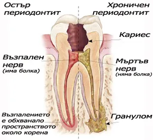 Периодонтит с гранулом около кореновия връх на зъб