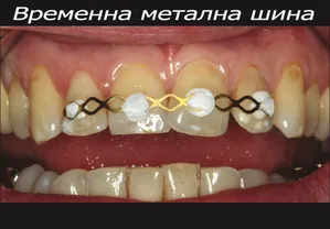Метална шина от лигатурна тел
