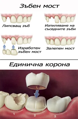 Металокерамичен мост с корони