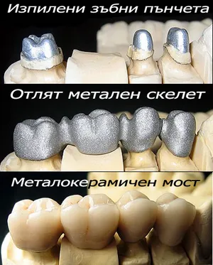 Металокерамичен мост