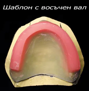 Оклузален шаблон с восъчни валове