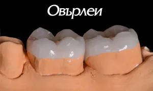 Керамичен овърлей — полукорона за дъвкателната повърхност
