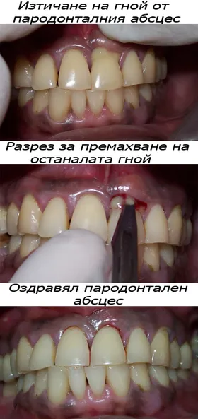 Пародонтален абсцес във венеца около зъб