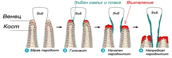 Схема на развитието на пародонтита – от плака и зъбен камък до загуба на кост