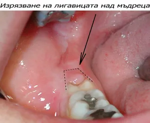Изрязване на възпалената лигавица над мъдрец