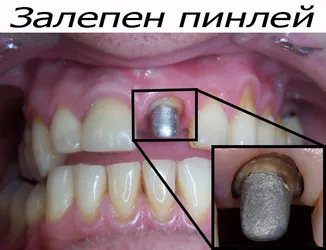 Пинлей, поставен в устата
