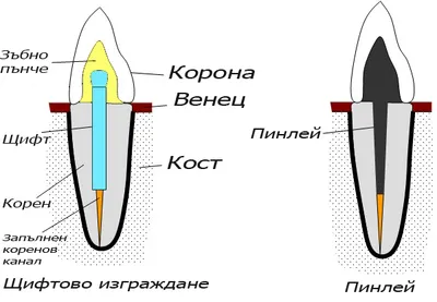 Схема на пинлей – коренов щифт и зъбно пънче, отлети като едно цяло