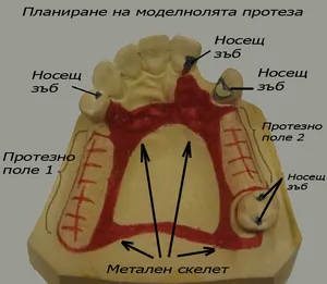 Планиране на моделно лята протеза върху гипсов модел