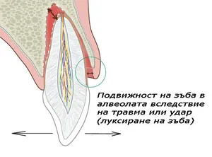 Подвижни зъби след удар