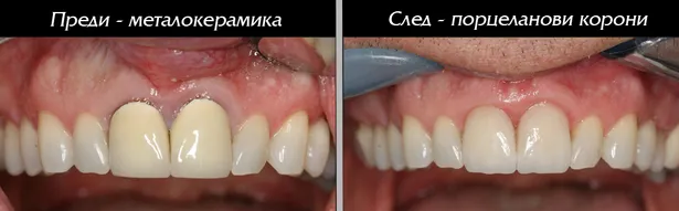 Порцеланови корони с оголен метален кант