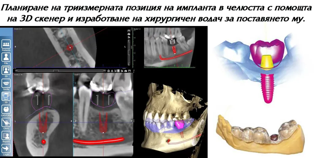 Планиране на позицията на импланта в 3D образ на челюстта