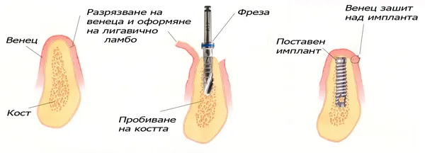 Етапи на поставяне на имплант