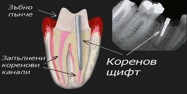Щифт в кореновия канал на зъб