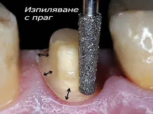 Прагово изпиляване на зъб