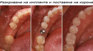 Имплант преди и след поставяне