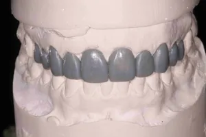 Восъчен прототип (Wax-up) на бъдещите фасети