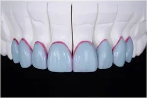Предварителен восъчен модел на зъби (Wax-Up) на бъдещата усмивка