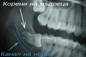 Рентгенова снимка на ретиниран мъдрец преди операция