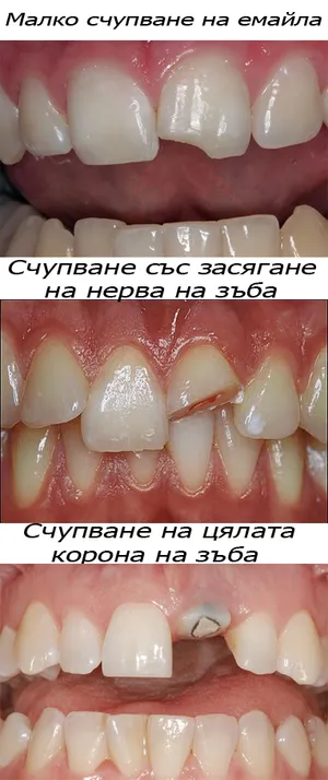 Счупен зъб – видове счупвания на корона и корен