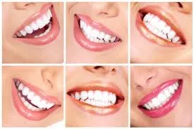 Красива усмивка след Smile Design с фасети