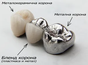 Видове зъбни корони