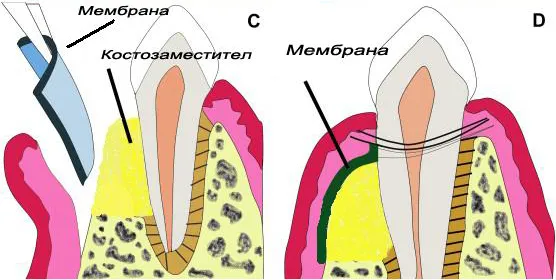 Водена костна регенерация — мембрана между венеца и костозаместителя