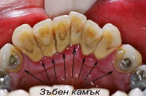 Зъбен камък в областта на шийките на зъбите